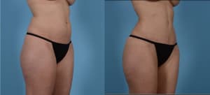 Mommy Makeover procedure image