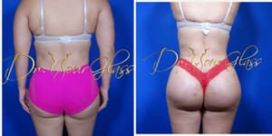 Hip Enhancement procedure image