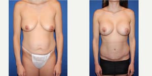 Breast Augmentation procedure image