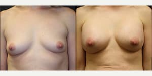 Mommy Makeover procedure image