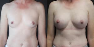 Breast Augmentation procedure image