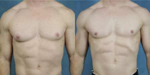 Facelift procedure image