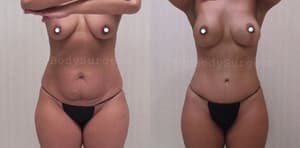 Mommy Makeover procedure image