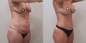 Tummy Tuck (Abdominoplasty) procedure image