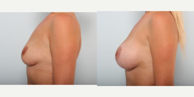 Breast Augmentation procedure image