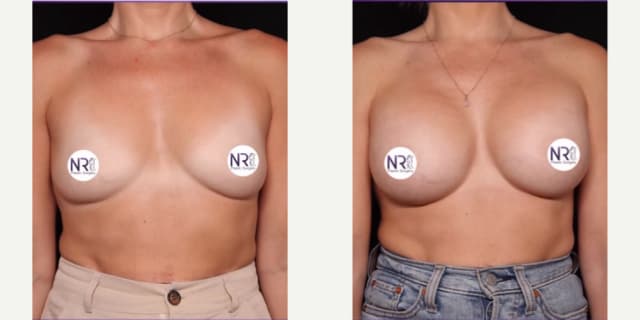 Mommy Makeover procedure image