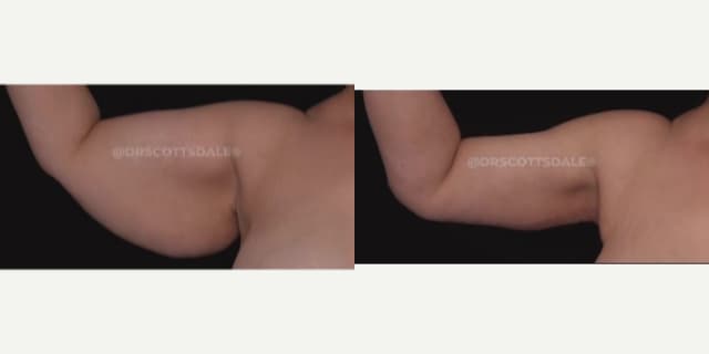 Body Lift procedure image