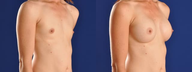 Mommy Makeover procedure image