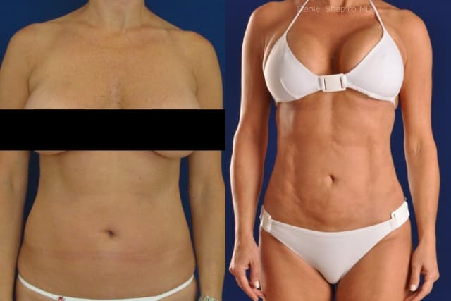 Lipo 360 procedure image