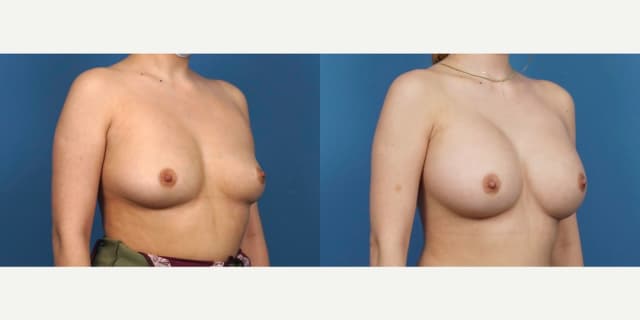 Mommy Makeover procedure image