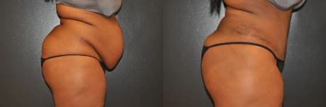 Skin Tightening procedure image