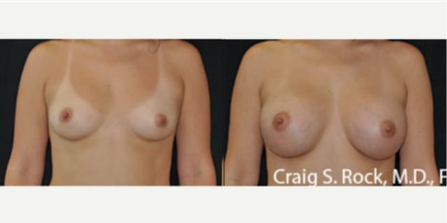 Mommy Makeover procedure image