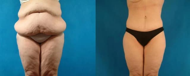 Skin Tightening procedure image