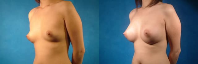 Breast Augmentation procedure image