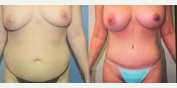 Tummy Tuck (Abdominoplasty) procedure image