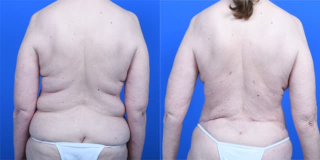 Skin Tightening procedure image