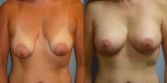 Mommy Makeover procedure image