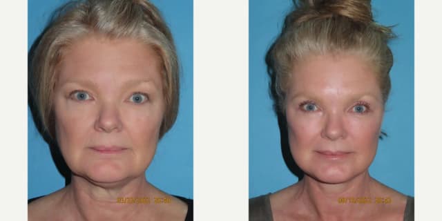 Facelift procedure image