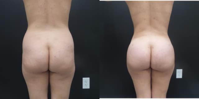 Breast Augmentation procedure image