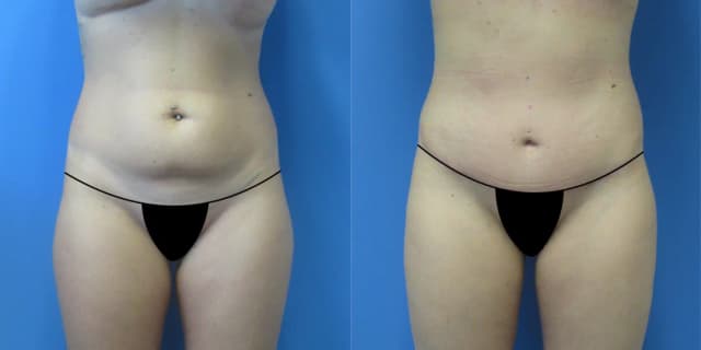 Mommy Makeover procedure image