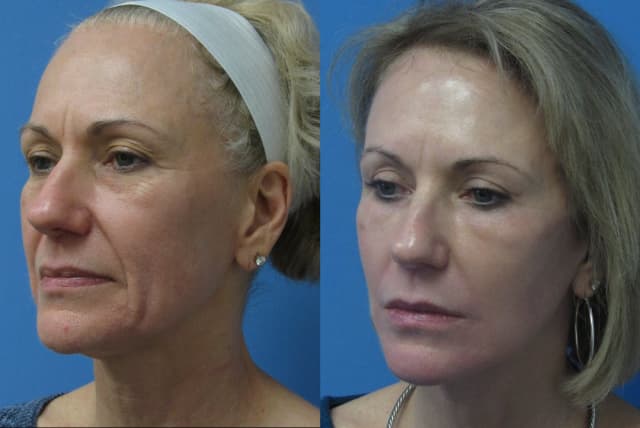 Facelift procedure image