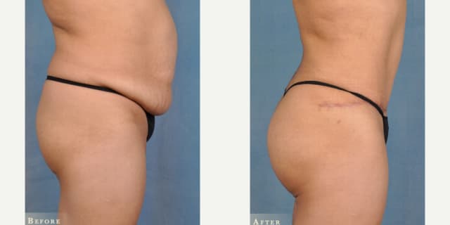 Skin Tightening procedure image