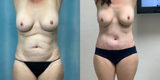 Mommy Makeover procedure image