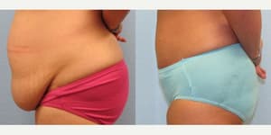 Skin Tightening procedure image