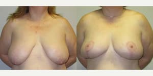 Mommy Makeover procedure image