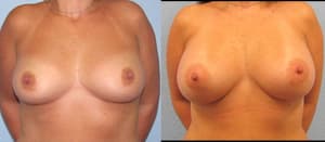 Breast Augmentation procedure image
