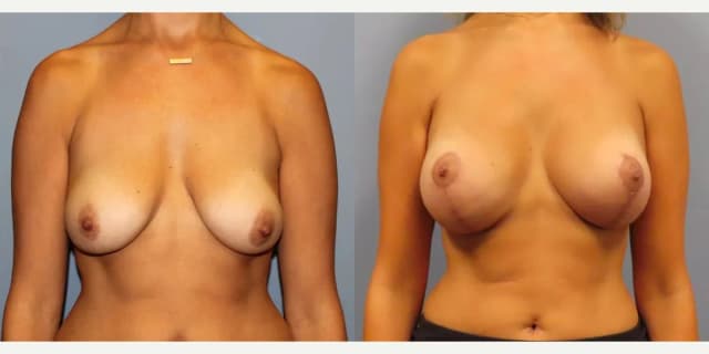 Breast Reduction (Mammoplasty) procedure image