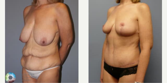 Breast Augmentation procedure image