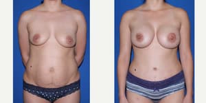 Mommy Makeover procedure image