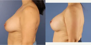 Skin Tightening procedure image
