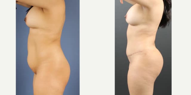 Breast Augmentation procedure image