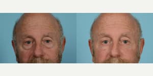 Eyelid Surgery (Blepharoplasty) procedure image