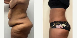 Tummy Tuck (Abdominoplasty) procedure image