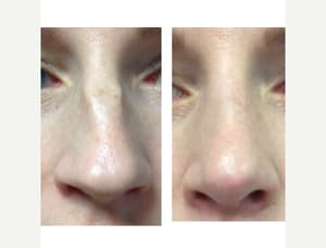Rhinoplasty (Nose Job) procedure image