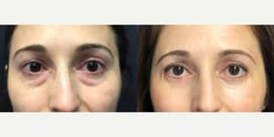 Eyelid Surgery (Blepharoplasty) procedure image