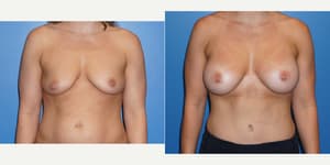 Skin Tightening procedure image