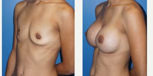 Mommy Makeover procedure image