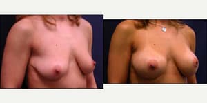 Mommy Makeover procedure image