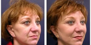 Eyelid Surgery (Blepharoplasty) procedure image