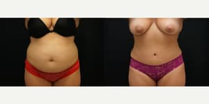 Tummy Tuck (Abdominoplasty) procedure image