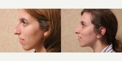Rhinoplasty (Nose Job) procedure image