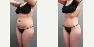 Mommy Makeover procedure image