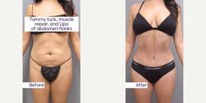 Tummy Tuck (Abdominoplasty) procedure image