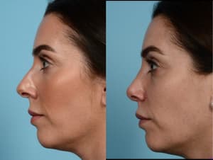 Facelift procedure image