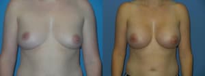 Breast Augmentation procedure image