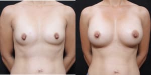 Breast Augmentation procedure image